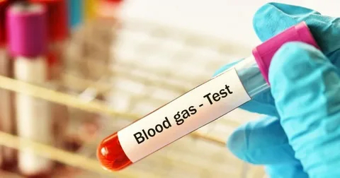 Arterial Blood Gas Test (ABG)